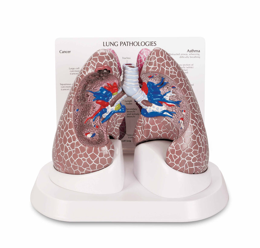 Lung Set with Pathologies [SKU: SB44894]
