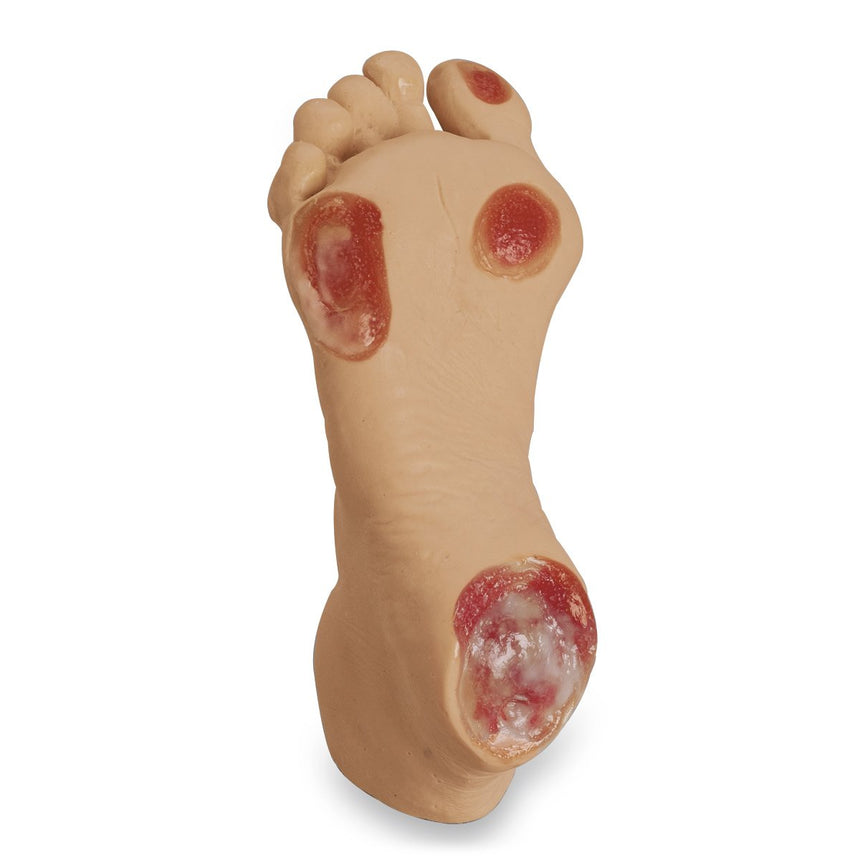 Life/form® Elderly Pressure Ulcer Foot - Light [SKU: LF00933]
